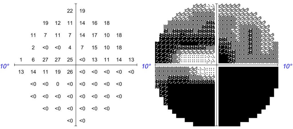 glaucoma damaged vision